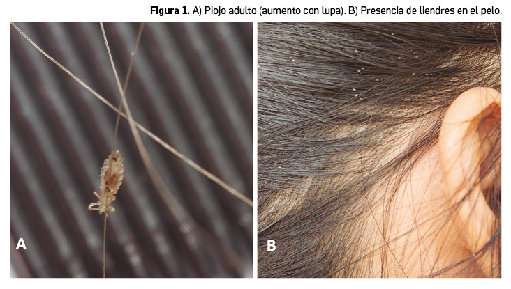 Adición abrazo especificación Pediculosis y su tratamiento - Farmacéuticos