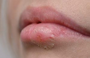 Herpes-labial Herpes labial