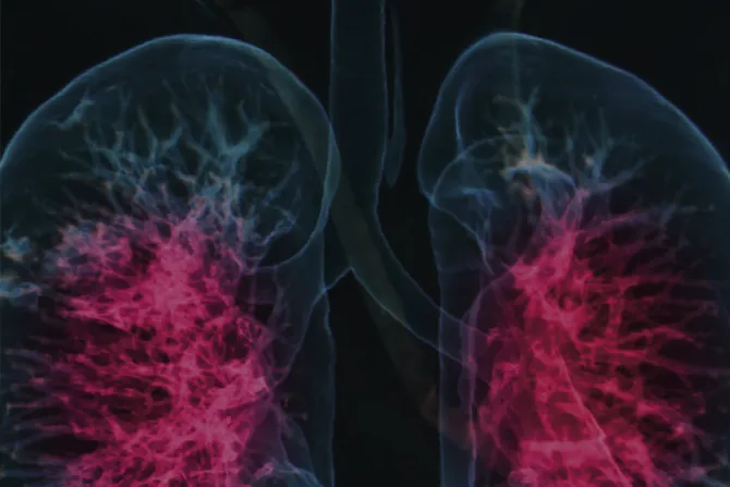 Enfermedad pulmonar obstructiva crónica