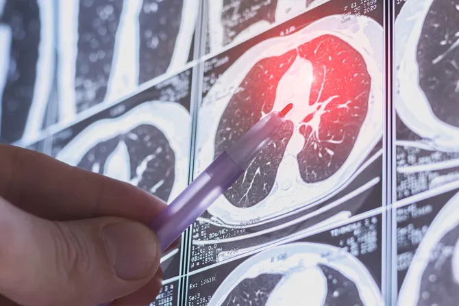 Enfermedad pulmonar intersticial