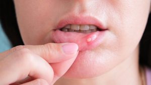 Aftas-bucales Aftas bucales