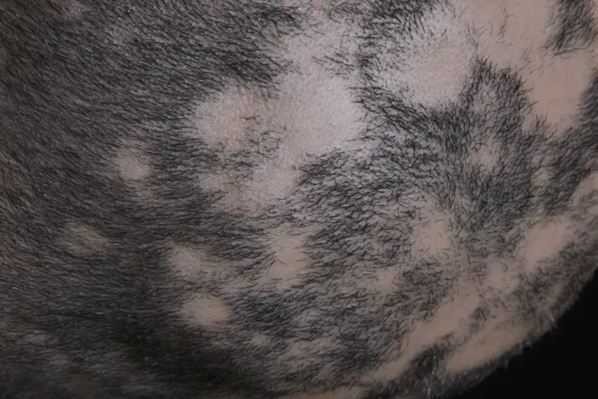 Alopecia areata