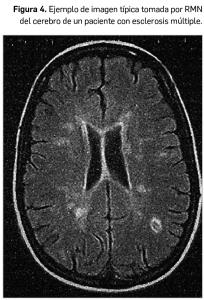 Revision_esclerosis_Figura4